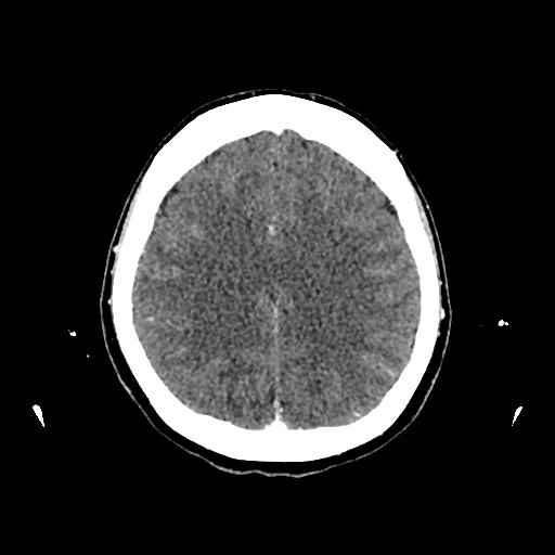 Cerebral venous thrombosis with venous hemorrhagic infarct (Radiopaedia 90354-107660 Axial with contrast 113).jpg