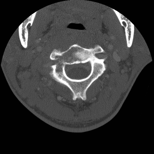 Cervical Pott disease (Radiopaedia 20374-20286 Axial bone window 39).jpg
