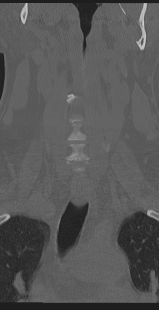 Cervical canal stenosis due to ossification of the posterior longitudinal ligament (Radiopaedia 47260-51823 Coronal bone window 11).png