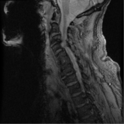File:Cervical canal stenosis with cord compression (Radiopaedia 34114-35374 D 14).png