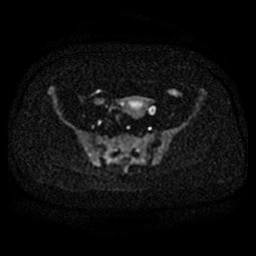File:Cervical carcinoma (Radiopaedia 67644-77047 Axial DWI 7).jpg