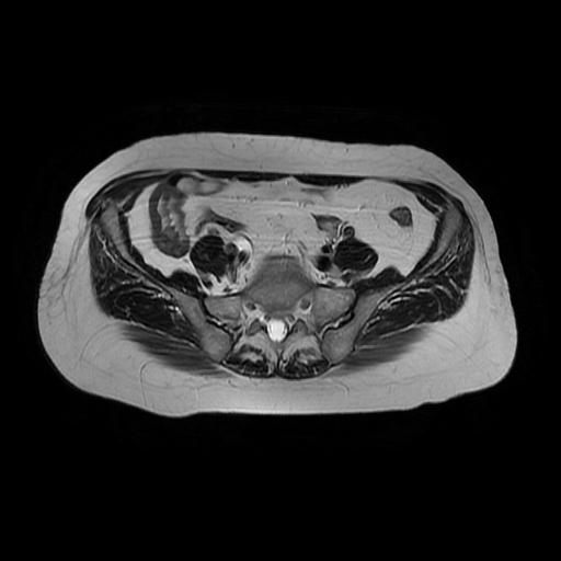 File:Cervical carcinoma (Radiopaedia 67644-77047 Axial T2 5).jpg