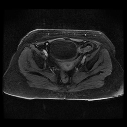 Cervical carcinoma (Radiopaedia 70924-81132 Axial T1 C+ fat sat 231).jpg