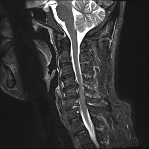 File:Cervical disc extrusion (Radiopaedia 53950-60077 Sagittal STIR 10).jpg