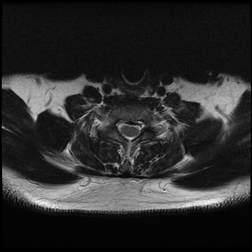 File:Cervical disc extrusion (Radiopaedia 59074-66364 Axial T2 14).jpg