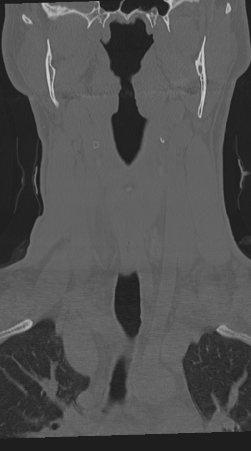 Cervical intercalary bone (Radiopaedia 35211-36748 Coronal bone window 21).png