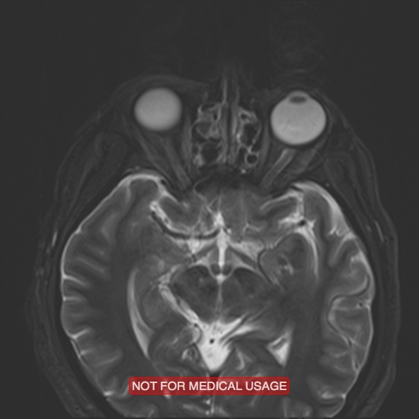 File:Cervical nerve schwannoma (Radiopaedia 27964-28221 C 8).jpg
