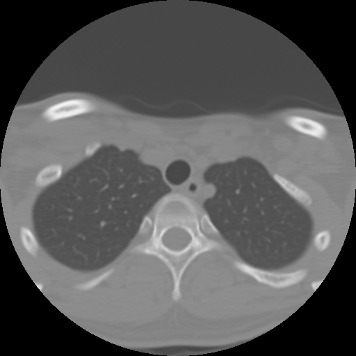 Cervical rib (Radiopaedia 71110-81363 Axial non-contrast 54).jpg