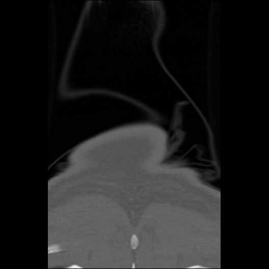 File:Cervical rib (Radiopaedia 71110-81363 Coronal non-contrast 1).jpg
