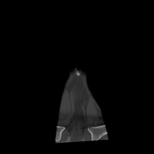 Cervical schwannoma (Radiopaedia 57979-64974 Coronal bone window 1).png
