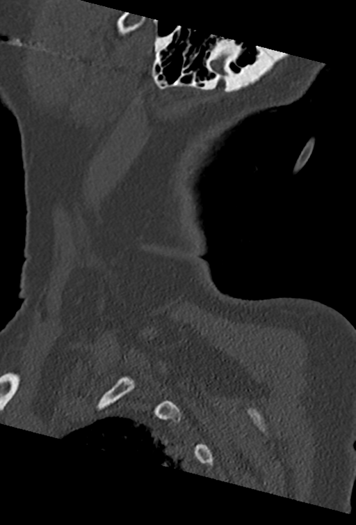 Cervical spine ACDF loosening (Radiopaedia 48998-54070 Sagittal bone window 78).png