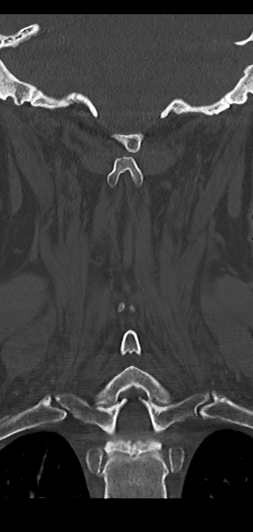 Cervical spine fracture - chalk stick (Radiopaedia 39116-41323 Coronal bone window 37).png