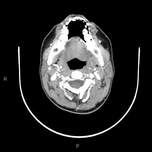 Cervical thymic cyst (Radiopaedia 88632-105335 B 83).jpg