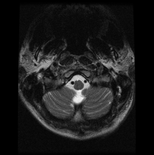 File:Cervical vertebrae metastasis (Radiopaedia 78814-91667 Axial T2 28).png
