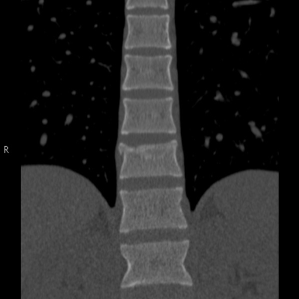 File:Chance fracture (Radiopaedia 36521-38081 Coronal bone window 18).jpg