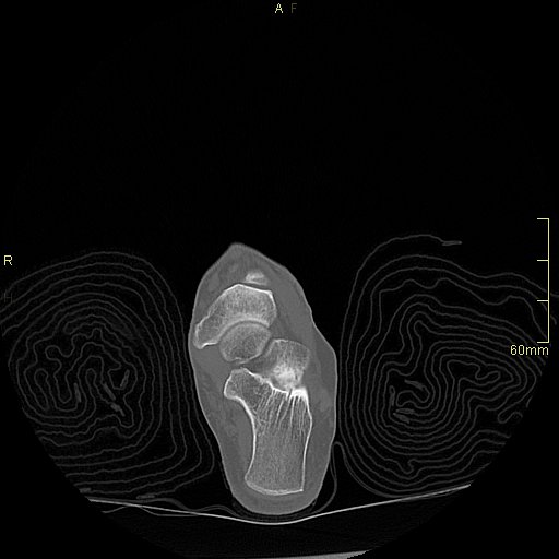 File:Chaput tubercle fracture (Radiopaedia 80319-93956 Axial non-contrast 33).jpg
