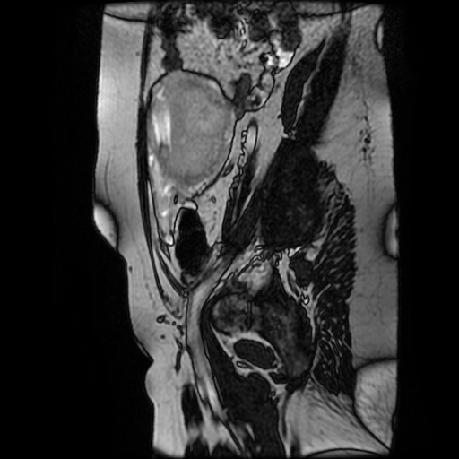 File:Chiari II malformation - fetal MRI (Radiopaedia 68099-77581 Sagittal Fiesta 45).jpg