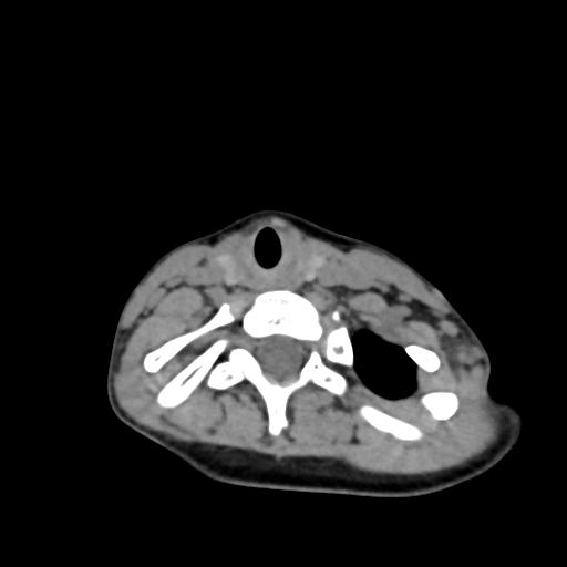 Chiari I with syrinx and skull base anomalies (Radiopaedia 89444-106412 Axial non-contrast 113).jpg