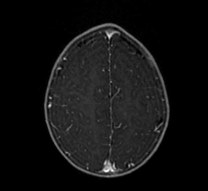 Chiasmatic-hypothalamic glioma (Radiopaedia 90079-107252 Axial T1 C+ 73).jpg