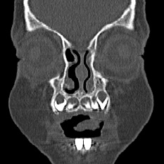 File:Choanal atresia (Radiopaedia 88525-105975 Coronal bone window 3).jpg