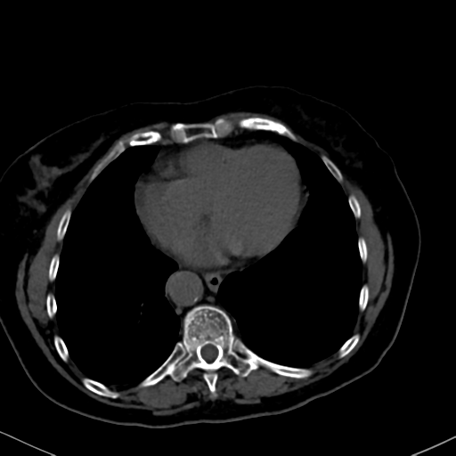 File:Cholecystitis - obstructive choledocholitiasis (CT intravenous cholangiography) (Radiopaedia 43966-47479 Axial 143).png