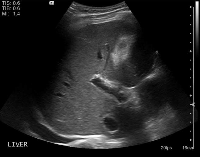 File:Cholecystitis - perforated gallbladder (Radiopaedia 57038-63913 A 2).jpg