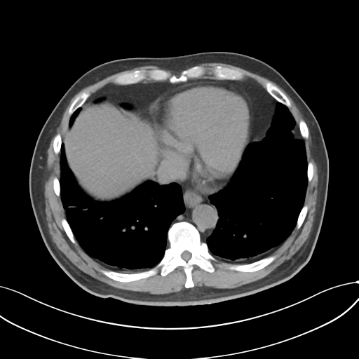 Cholecystitis with focal perforation and hepatic abscess (Radiopaedia 37189-38945 Axial non-contrast 8).png