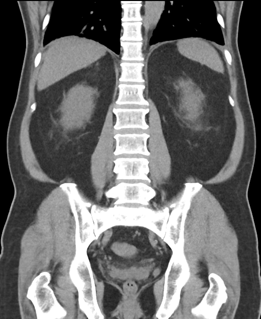 Cholecystitis with focal perforation and hepatic abscess (Radiopaedia 37189-38945 Coronal non-contrast 41).png