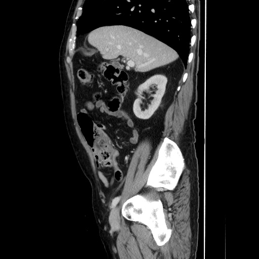 Choledocholiathiasis with normal caliber common bile duct (Radiopaedia 75368-86632 D 58).jpg