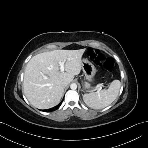File:Choledocholithiasis after recent cholecystectomy (Radiopaedia 60929-68737 Axial 47).jpg