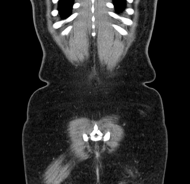 Choledocholithiasis on CT and MRI (Radiopaedia 24825-25087 C 51).jpg