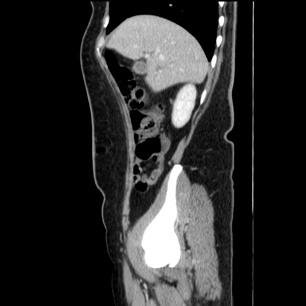 Choledocholithiasis on CT and MRI (Radiopaedia 24825-25087 D 17).jpg