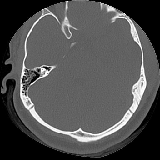 Cholesteatoma (Radiopaedia 84960-100474 Axial bone window 30).jpg