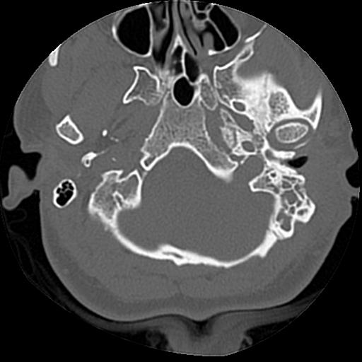 Cholesteatoma (Radiopaedia 84960-100474 Axial bone window 55).jpg