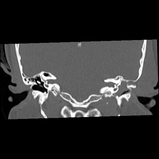 Cholesteatoma (Radiopaedia 84960-100474 Coronal bone window 33).jpg