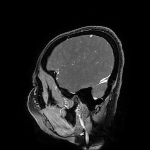 Chordoid glioma of third ventricle (Radiopaedia 91612-109340 F 168).jpg