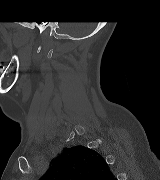 File:Chordoma (C4 vertebra) (Radiopaedia 47561-52188 Sagittal bone window 16).png