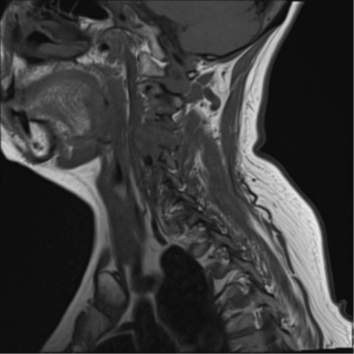 File:Chordoma (C4 vertebra) (Radiopaedia 47561-52189 Sagittal T1 11).png