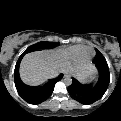 File:Choriocarcinoma of ovary with cerebral and pulmonary metastases (Radiopaedia 25983-26119 Axial non-contrast 26).jpg