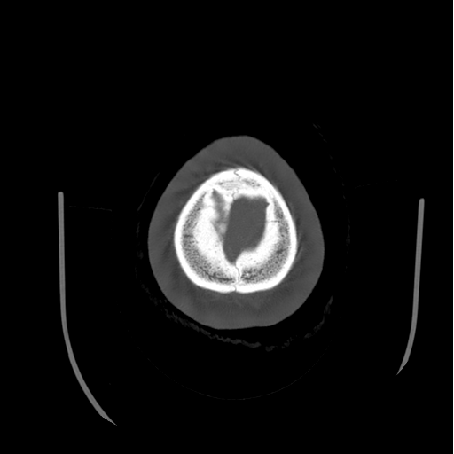 Choroid plexus papilloma extending into the cerebellopontine angle cistern (Radiopaedia 85941-101833 Axial bone window 88).png