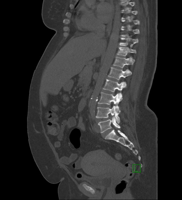 Chromophobe renal cell carcinoma (Radiopaedia 84239-99519 Sagittal bone window 54).jpg
