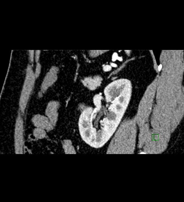 Chromophobe renal cell carcinoma (Radiopaedia 84286-99573 F 49).jpg