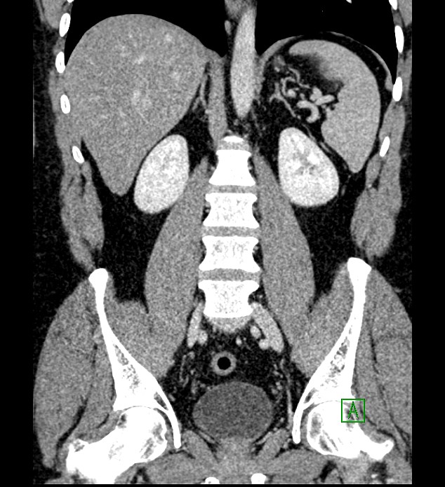 Chromophobe renal cell carcinoma (Radiopaedia 84286-99573 H 113).jpg