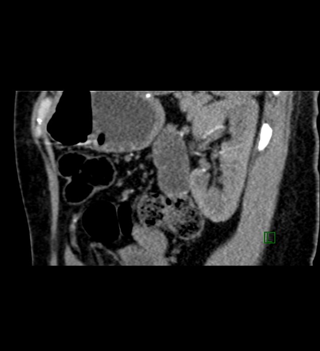 Chromophobe renal cell carcinoma (Radiopaedia 84290-99582 D 29).jpg