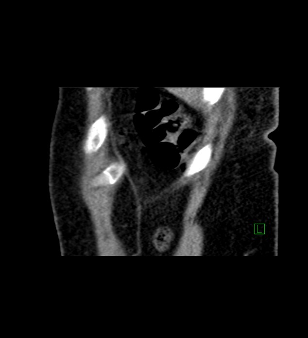 Chromophobe renal cell carcinoma (Radiopaedia 84290-99582 D 6).jpg