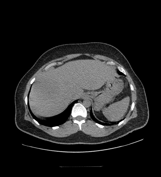 Chromophobe renal cell carcinoma (Radiopaedia 84337-99644 Axial non-contrast 15).jpg