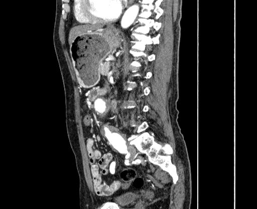 File:Chronic contained rupture of abdominal aortic aneurysm with extensive erosion of the vertebral bodies (Radiopaedia 55450-61901 B 45).jpg