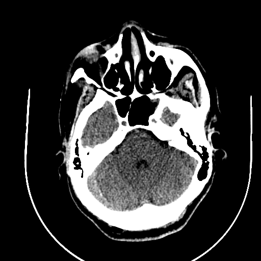 Chronic invasive fungal sinusitis (Radiopaedia 91563-109286 Axial non-contrast 22).jpg