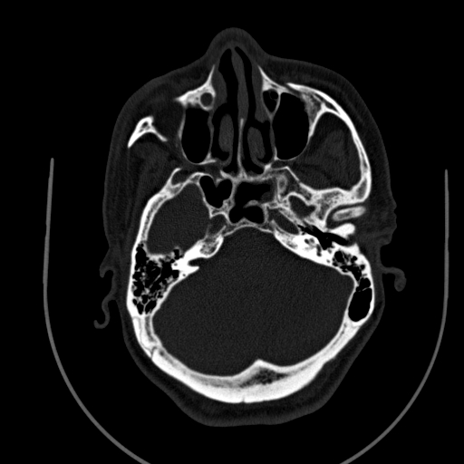 Chronic invasive fungal sinusitis (Radiopaedia 91563-109286 Axial sinus 44).jpg