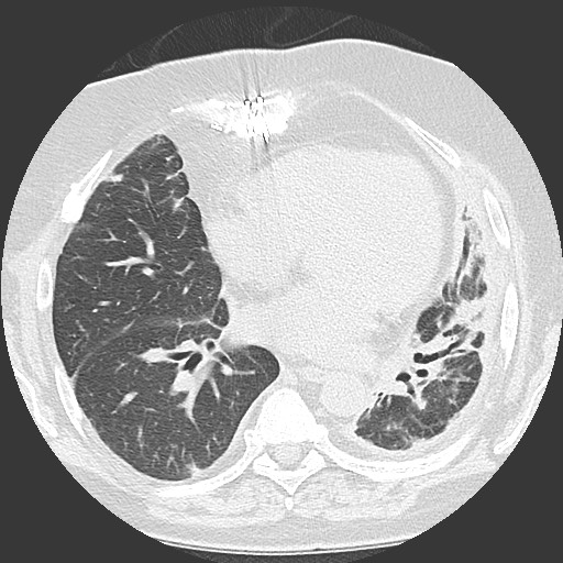 Chronic lung allograft dysfunction - restrictive form (Radiopaedia 60595-68316 Axial lung window 41).jpg